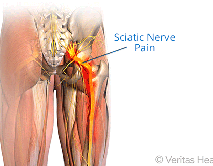 sciatic-nerve-pain